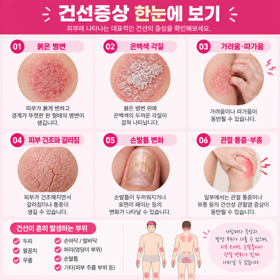 얼굴건선 관련 이미지 5