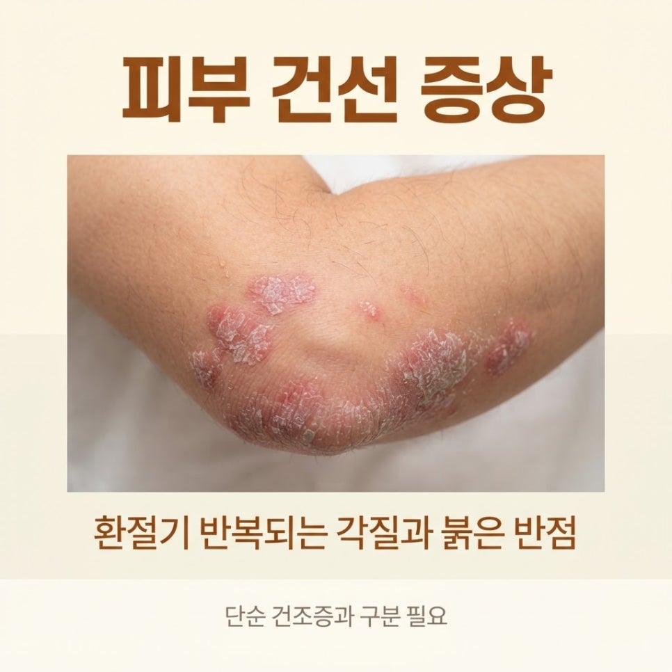피부 건선 증상 관련 이미지 3